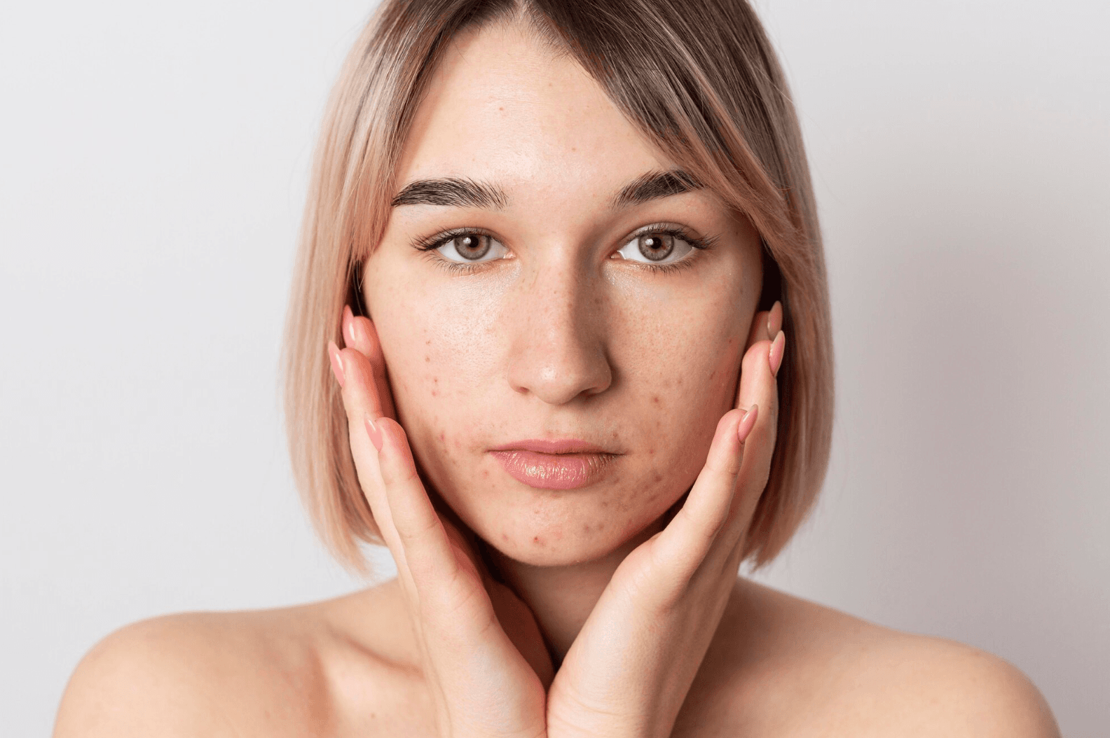 Hormonální akné a psychosomatika: co je dobré vědět